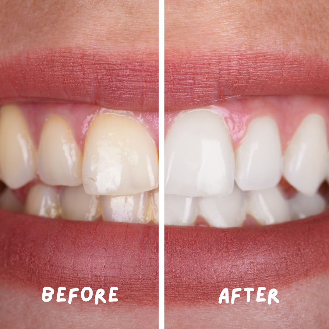 Ayurvedic Teeth Whitening Liquid