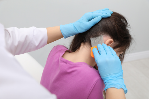 The Complete Lice-Free Guide: How to Detect, Treat, and Prevent Head Lice Naturally (Without Harsh Chemicals)